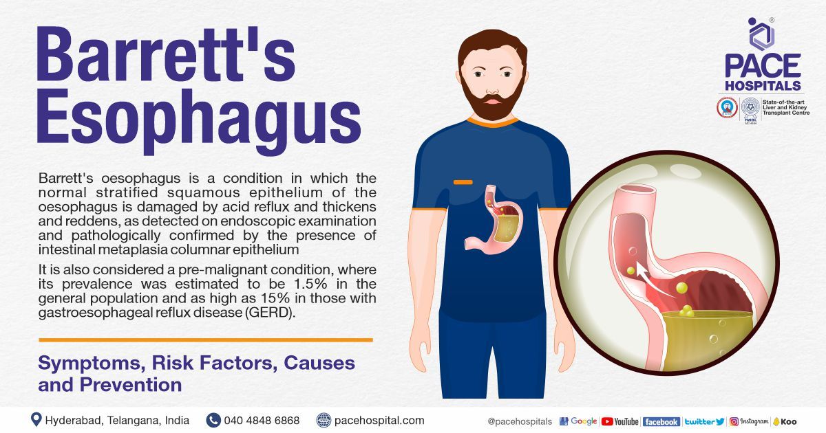 What is Barrett’s Esophagus
